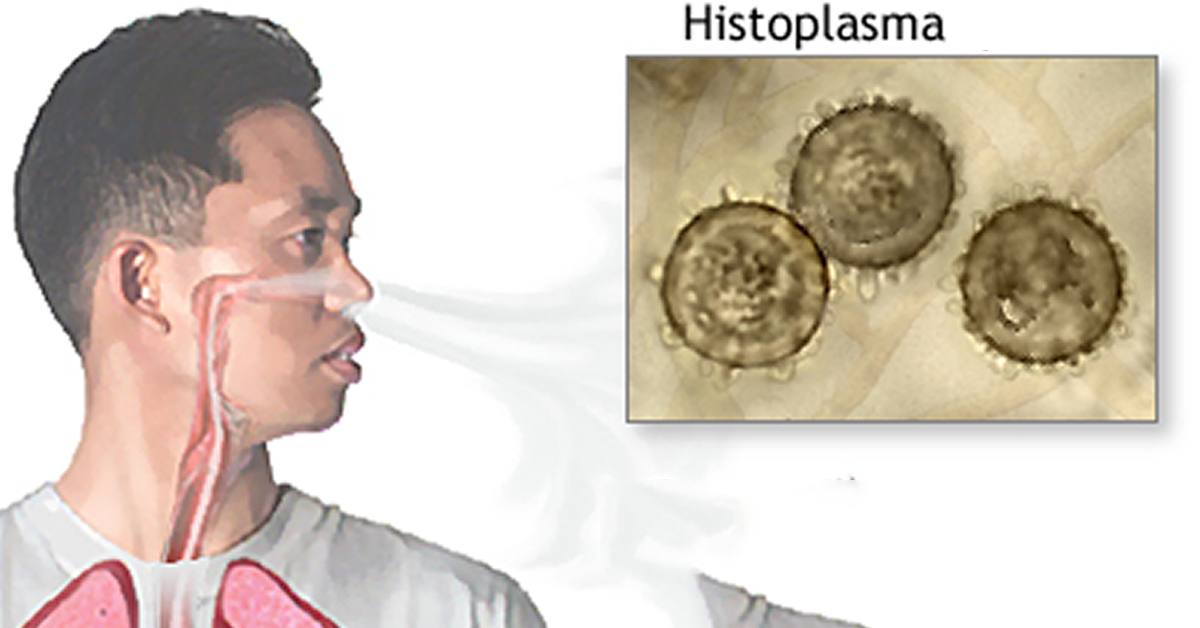 Histoplasmosis